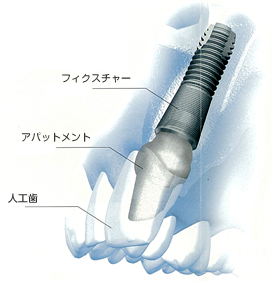 歯を失ってお悩みの方へ